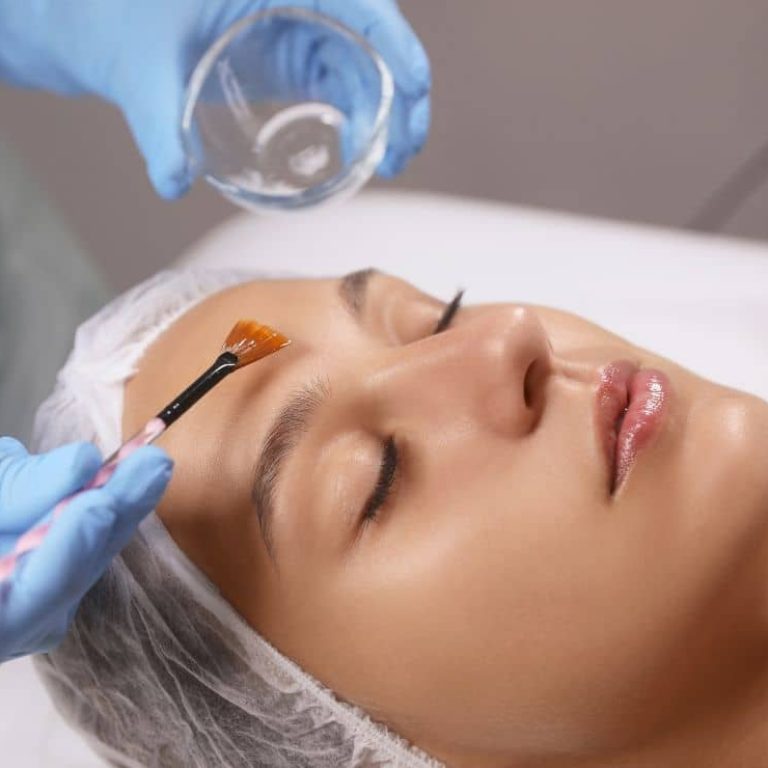 benefits of chemical peel