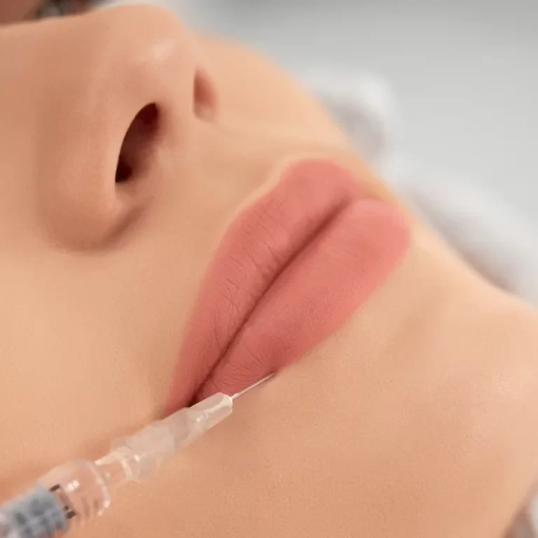 Dermal Fillers
